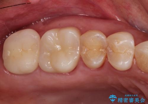感染した奥歯　痛くて咬めない　根管治療→かぶせ物で痛みを取り除き、かみ合わせを回復するの治療後