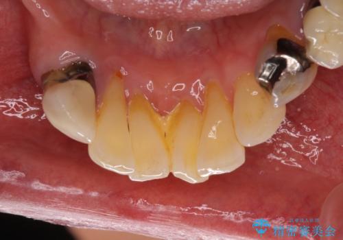 インプラントと入れ歯による全顎補綴治療の治療前