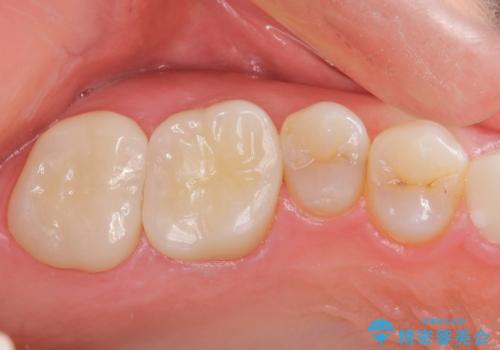 根っこの感染 再治療をしてかぶせ物を製作するの治療後