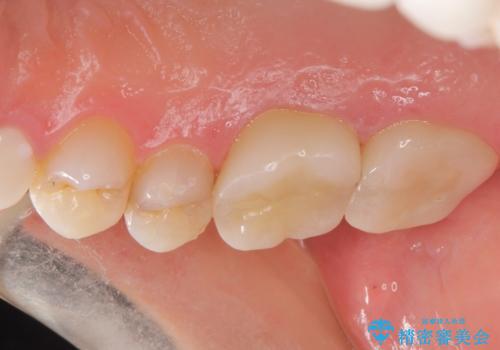 根っこの感染 再治療をしてかぶせ物を製作するの治療後