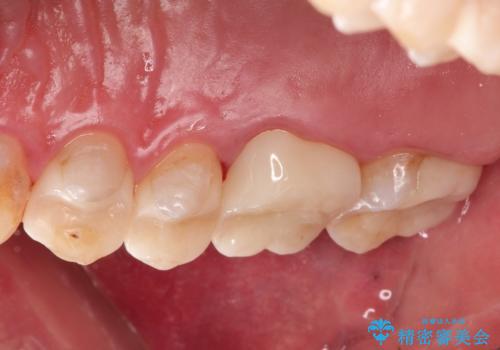 金属だらけの奥歯 根管治療のやり直しとセラミック化の治療後