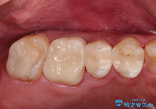金属だらけの奥歯 根管治療のやり直しとセラミック化の症例 治療後