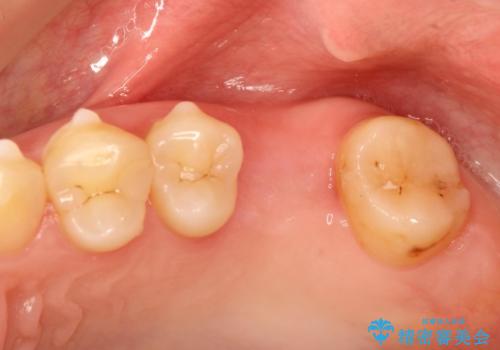 奥歯が割れてしまった! → インプラントによるかみ合わせの回復の治療前