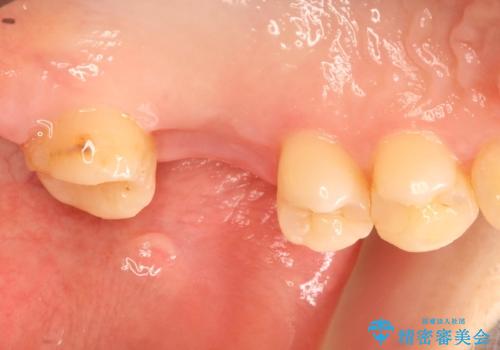 奥歯が割れてしまった! → インプラントによるかみ合わせの回復の治療前