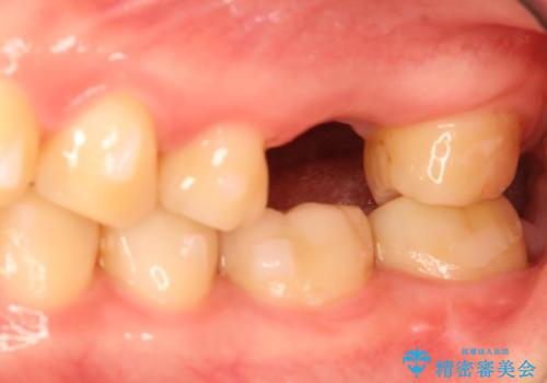 奥歯が割れてしまった! → インプラントによるかみ合わせの回復の治療前