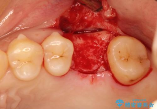 奥歯が割れてしまった! → インプラントによるかみ合わせの回復の治療中