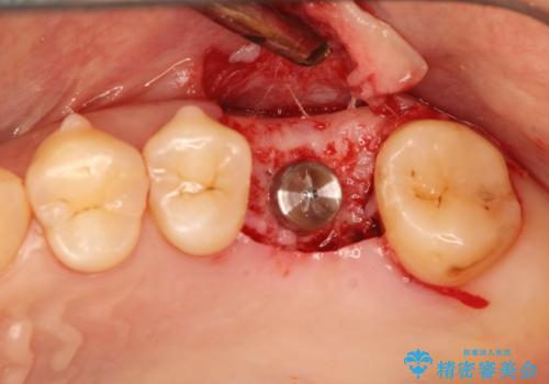 奥歯が割れてしまった! → インプラントによるかみ合わせの回復の治療中
