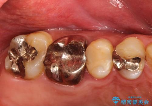 金属だらけの奥歯　根管治療のやり直しとセラミック化の治療前