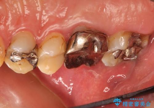 金属だらけの奥歯 根管治療のやり直しとセラミック化の治療前