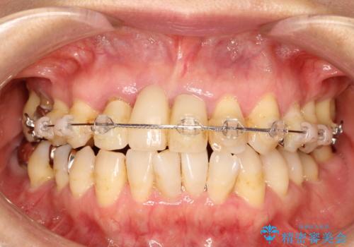 矯正を併用した前歯のセラミックブリッジ治療の治療後