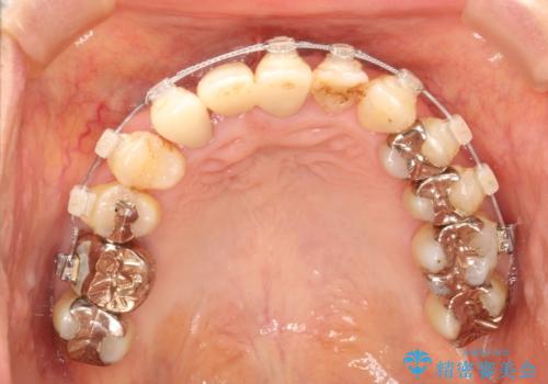 矯正を併用した前歯のセラミックブリッジ治療の治療後