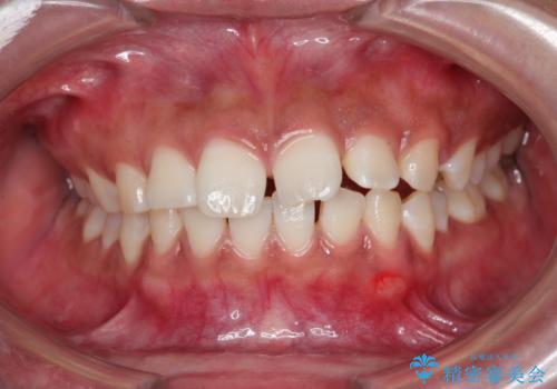 気になる出っ歯とすきっ歯をインビザラインで改善の症例 治療前