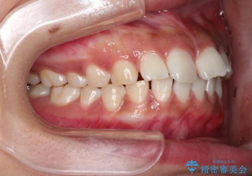 気になる出っ歯とすきっ歯をインビザラインで改善の治療前