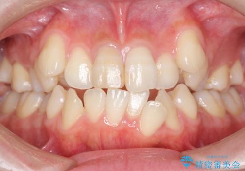 八重歯　前歯のがたがた　抜歯してワイヤー矯正の症例 治療前