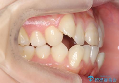 八重歯　前歯のがたがた　抜歯してワイヤー矯正の治療前
