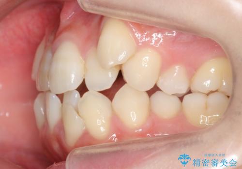 八重歯 前歯のがたがた 抜歯してワイヤー矯正の治療前