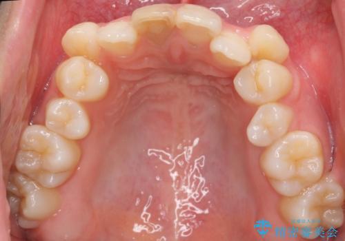 八重歯 前歯のがたがた 抜歯してワイヤー矯正の治療前