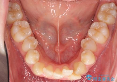 八重歯 前歯のがたがた 抜歯してワイヤー矯正の治療前
