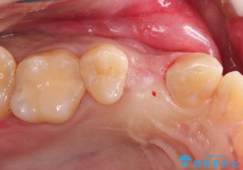 インプラントによる咬合回復の治療前