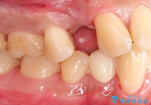 インプラントによる咬合回復の治療前