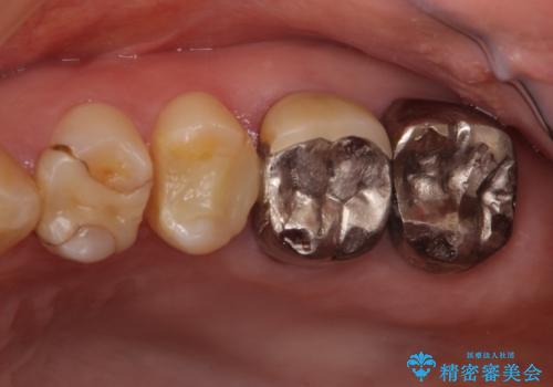 奥歯のクラウン周りが腫れる　精密治療による腫脹の改善の治療前