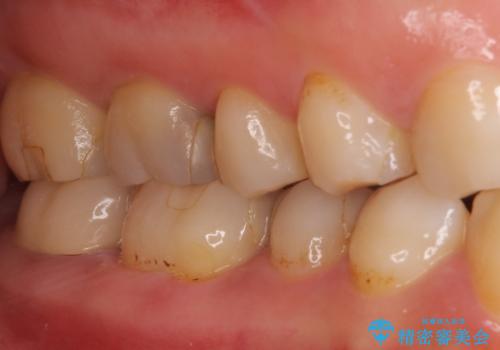 奥歯のクラウン周りが腫れる　精密治療による腫脹の改善の治療前