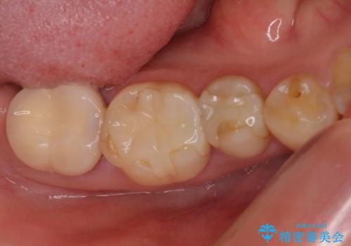 奥歯のクラウン周りが腫れる　精密治療による腫脹の改善の症例 治療前
