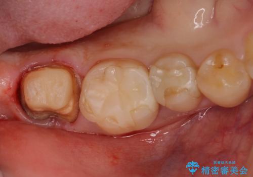 奥歯のクラウン周りが腫れる　精密治療による腫脹の改善の治療中