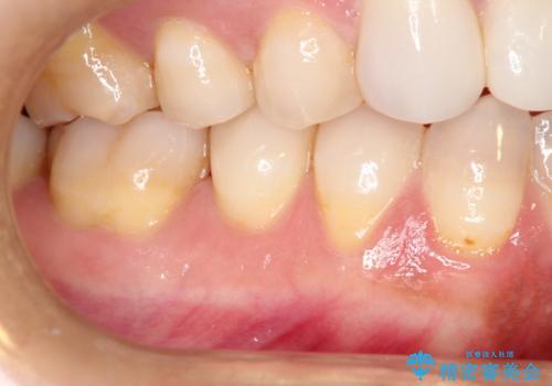 下がってしまった歯肉を元に戻したいが、自分の歯ぐきを移植するのは気が進まない : バイオマテリアルを応用した歯肉退縮への手術的対応の治療前