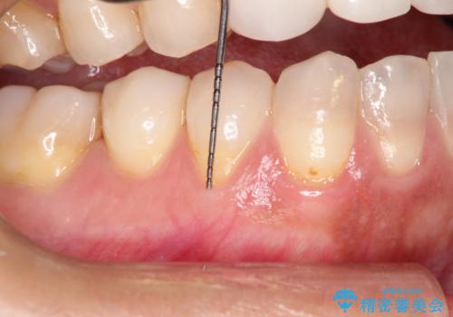 下がってしまった歯肉を元に戻したいが、自分の歯ぐきを移植するのは気が進まない : バイオマテリアルを応用した歯肉退縮への手術的対応の治療前