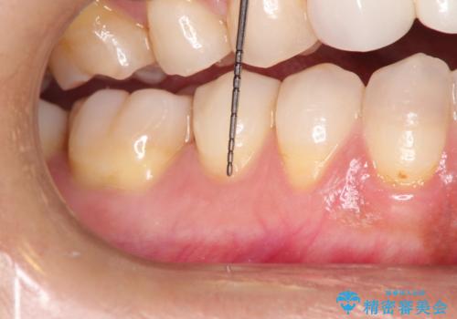 下がってしまった歯肉を元に戻したいが、自分の歯ぐきを移植するのは気が進まない : バイオマテリアルを応用した歯肉退縮への手術的対応の治療前