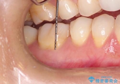 下がってしまった歯肉を元に戻したいが、自分の歯ぐきを移植するのは気が進まない : バイオマテリアルを応用した歯肉退縮への手術的対応の治療前