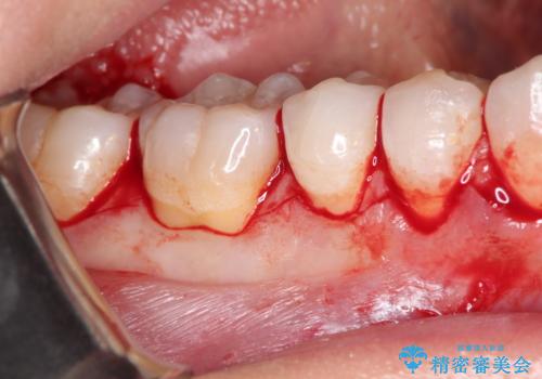 下がってしまった歯肉を元に戻したいが、自分の歯ぐきを移植するのは気が進まない : バイオマテリアルを応用した歯肉退縮への手術的対応の治療中