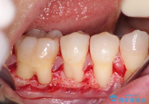 下がってしまった歯肉を元に戻したいが、自分の歯ぐきを移植するのは気が進まない : バイオマテリアルを応用した歯肉退縮への手術的対応の治療中