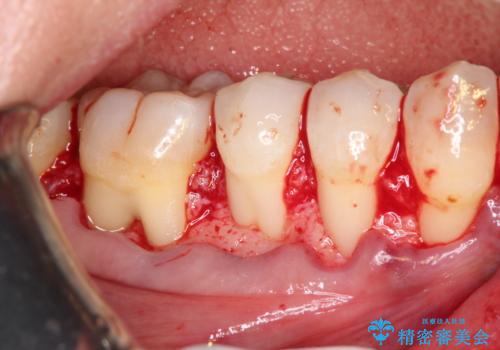 下がってしまった歯肉を元に戻したいが、自分の歯ぐきを移植するのは気が進まない : バイオマテリアルを応用した歯肉退縮への手術的対応の治療中