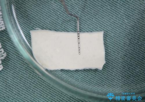 下がってしまった歯肉を元に戻したいが、自分の歯ぐきを移植するのは気が進まない : バイオマテリアルを応用した歯肉退縮への手術的対応の治療中