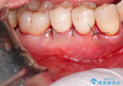 下がってしまった歯肉を元に戻したいが、自分の歯ぐきを移植するのは気が進まない : バイオマテリアルを応用した歯肉退縮への手術的対応の治療中