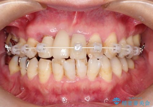 矯正を併用した前歯のセラミックブリッジ治療の治療中