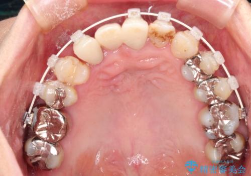 矯正を併用した前歯のセラミックブリッジ治療の治療中