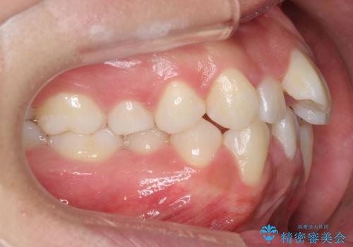 八重歯 抜かずにマウスピース矯正治療の治療前