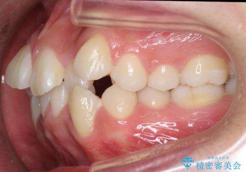 八重歯 抜かずにマウスピース矯正治療の治療前