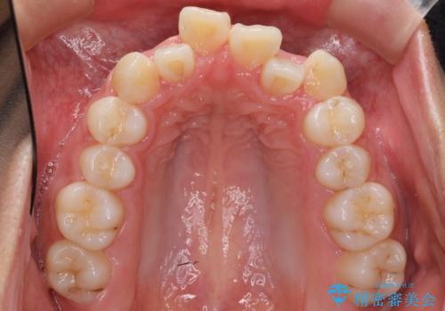 八重歯 抜かずにマウスピース矯正治療の治療前