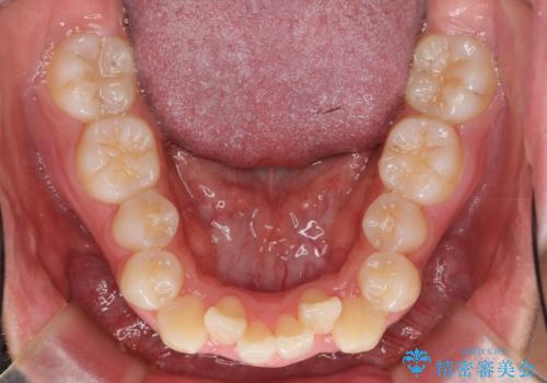 八重歯 抜かずにマウスピース矯正治療の治療前