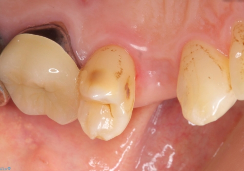 歯がわれた　抜歯してインプラント　50代男性の治療前