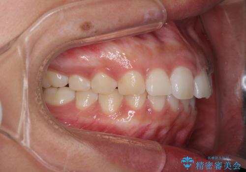 気になる出っ歯とすきっ歯をインビザラインで改善の治療中