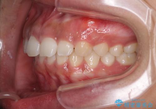 気になる出っ歯とすきっ歯をインビザラインで改善の治療中