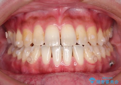 Invisalign インビザライン によるガタつき、受け口傾向の改善の治療中