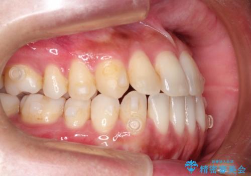 Invisalign インビザライン によるガタつき、受け口傾向の改善の治療中