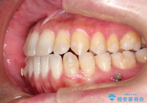 Invisalign インビザライン によるガタつき、受け口傾向の改善の治療中