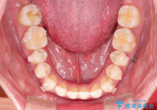 Invisalign インビザライン によるガタつき、受け口傾向の改善の治療中